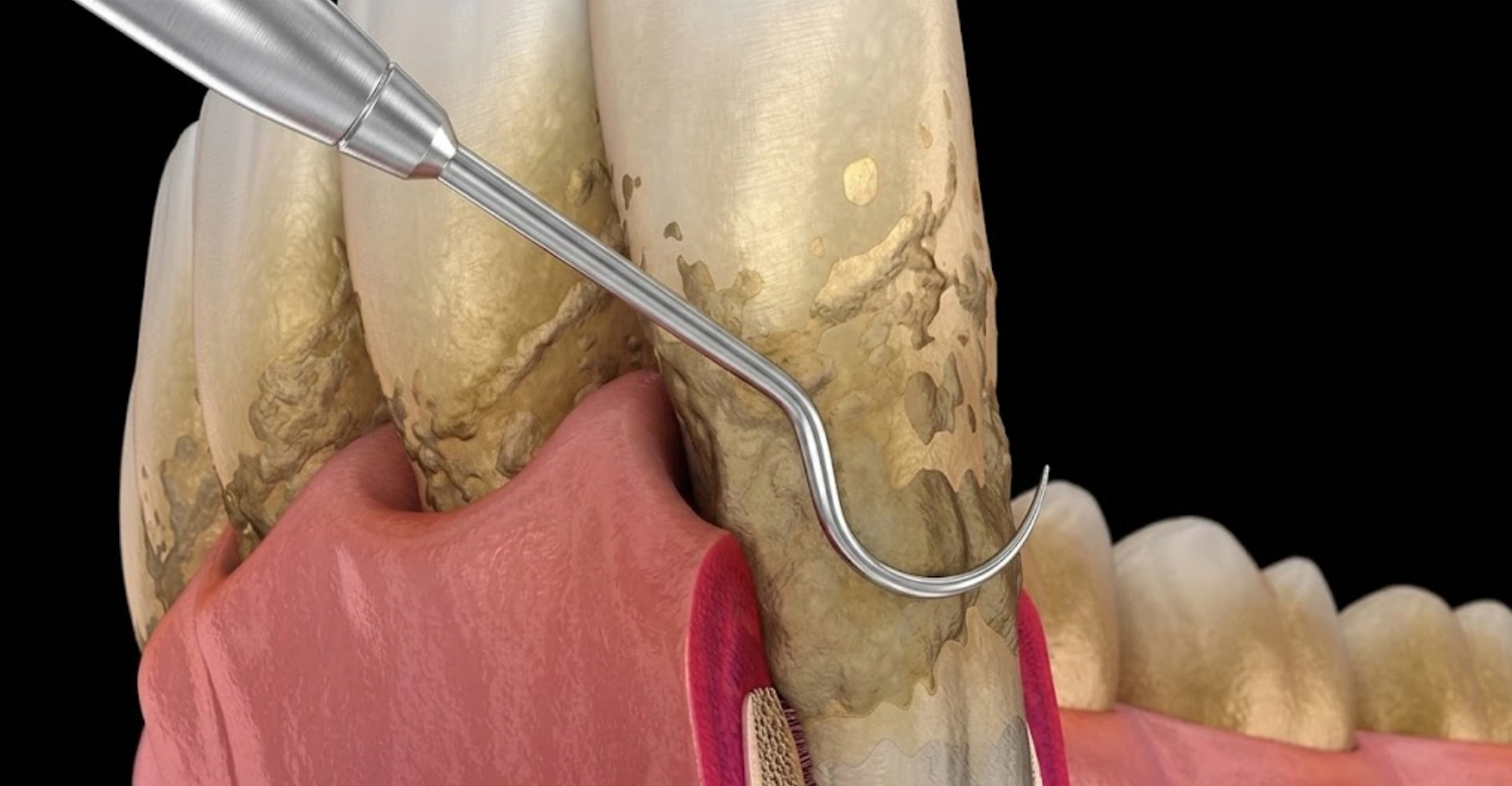 Non Surgical Periodontal Therapy Inblog